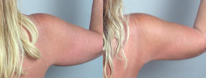 Upper Arm Rejuvenation Case 824 Before & After View #4 | Paramus, New Jersey | Parker Center for Plastic Surgery