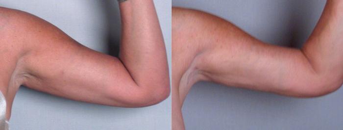 Upper Arm Rejuvenation Case 825 Before & After View #2 | Paramus, New Jersey | Parker Center for Plastic Surgery