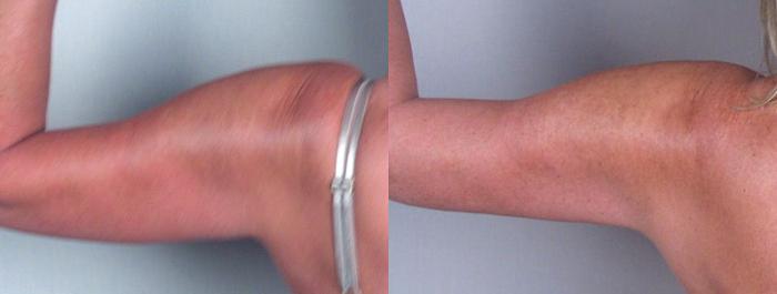 Upper Arm Rejuvenation Case 825 Before & After View #3 | Paramus, New Jersey | Parker Center for Plastic Surgery