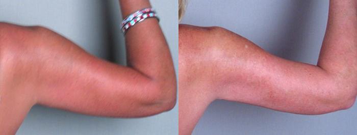 Upper Arm Rejuvenation Case 825 Before & After View #4 | Paramus, New Jersey | Parker Center for Plastic Surgery
