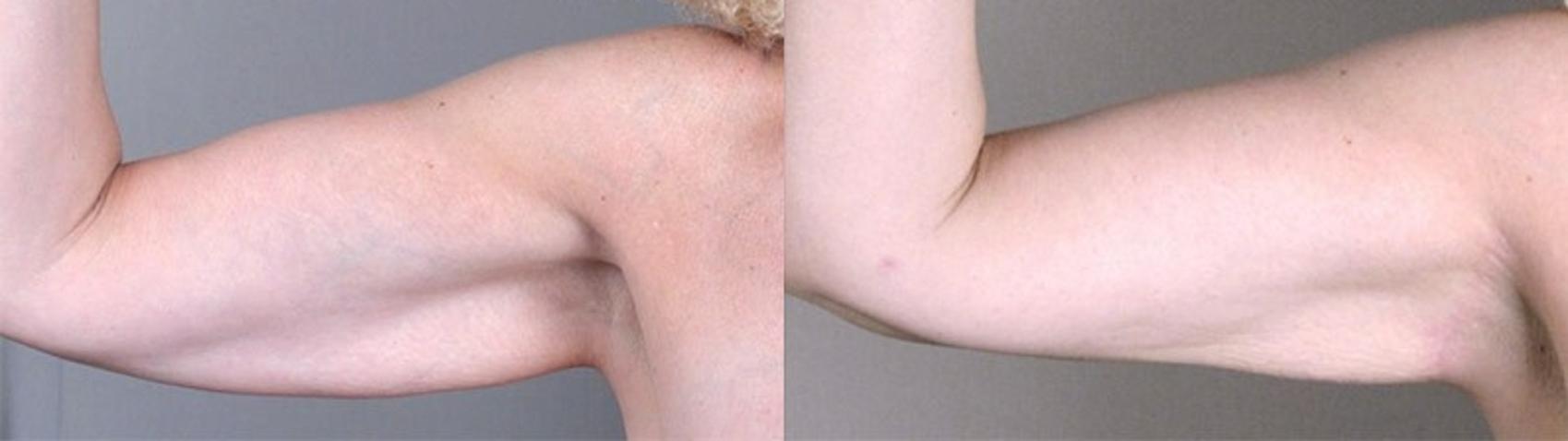 Upper Arm Rejuvenation Case 826 Before & After View #1 | Paramus, New Jersey | Parker Center for Plastic Surgery