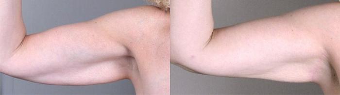 Upper Arm Rejuvenation Case 826 Before & After View #1 | Paramus, New Jersey | Parker Center for Plastic Surgery