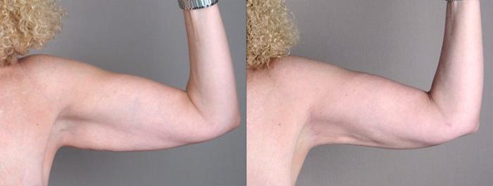 Upper Arm Rejuvenation Case 826 Before & After View #2 | Paramus, New Jersey | Parker Center for Plastic Surgery