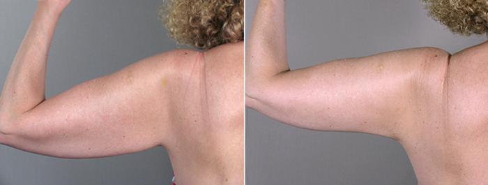 Upper Arm Rejuvenation Case 826 Before & After View #3 | Paramus, New Jersey | Parker Center for Plastic Surgery