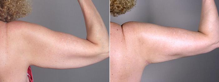 Upper Arm Rejuvenation Case 826 Before & After View #4 | Paramus, New Jersey | Parker Center for Plastic Surgery