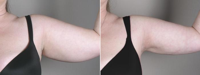 Upper Arm Rejuvenation Case 827 Before & After View #2 | Paramus, New Jersey | Parker Center for Plastic Surgery