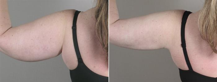 Upper Arm Rejuvenation Case 827 Before & After View #3 | Paramus, New Jersey | Parker Center for Plastic Surgery