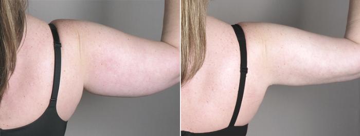 Upper Arm Rejuvenation Case 827 Before & After View #4 | Paramus, New Jersey | Parker Center for Plastic Surgery
