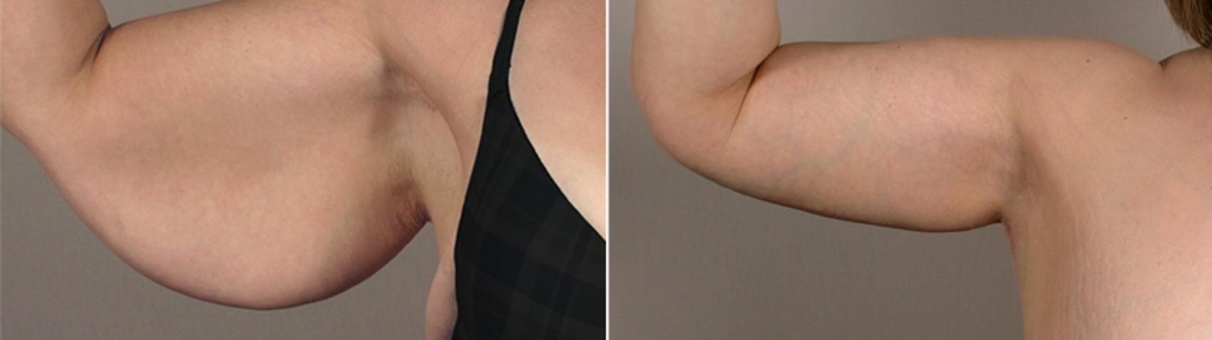 Upper Arm Rejuvenation Case 828 Before & After View #1 | Paramus, New Jersey | Parker Center for Plastic Surgery