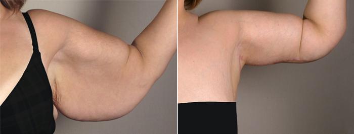 Upper Arm Rejuvenation Case 828 Before & After View #2 | Paramus, New Jersey | Parker Center for Plastic Surgery
