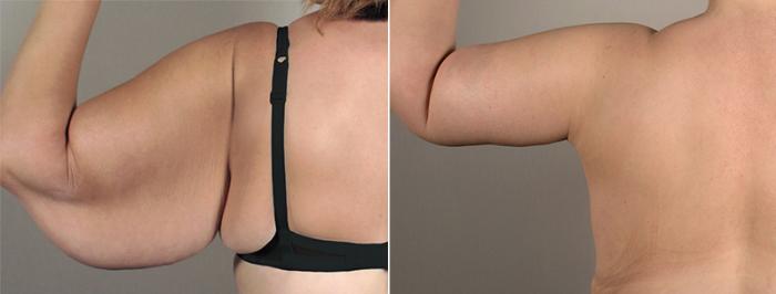 Upper Arm Rejuvenation Case 828 Before & After View #3 | Paramus, New Jersey | Parker Center for Plastic Surgery