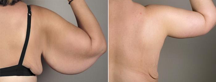 Upper Arm Rejuvenation Case 828 Before & After View #4 | Paramus, New Jersey | Parker Center for Plastic Surgery