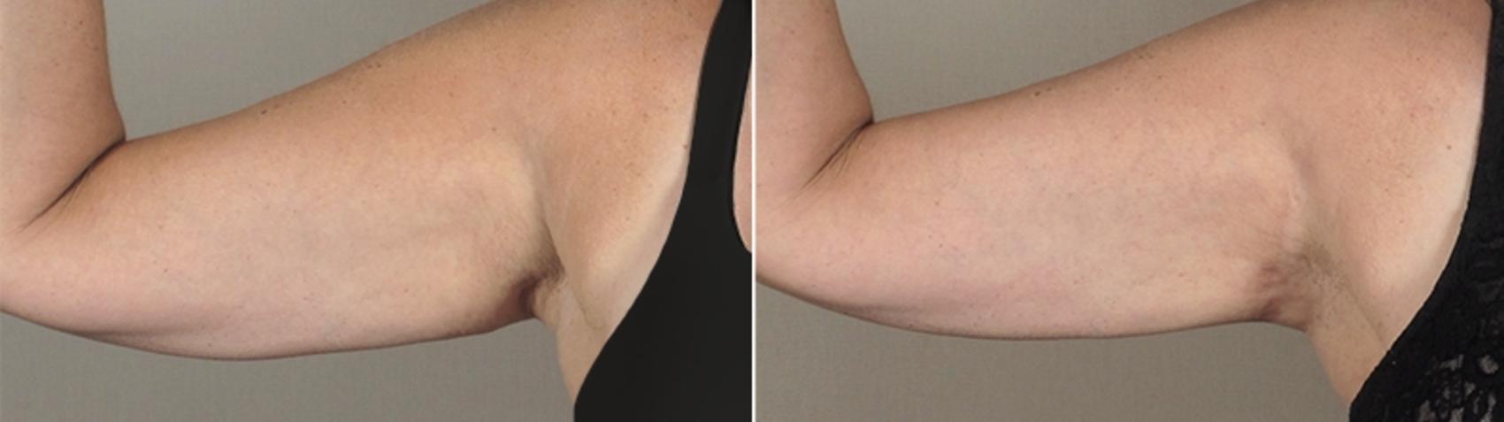 Upper Arm Rejuvenation Case 829 Before & After View #1 | Paramus, New Jersey | Parker Center for Plastic Surgery