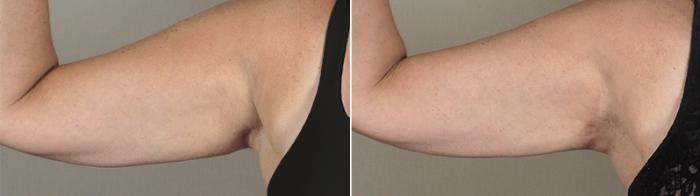 Upper Arm Rejuvenation Case 829 Before & After View #1 | Paramus, New Jersey | Parker Center for Plastic Surgery