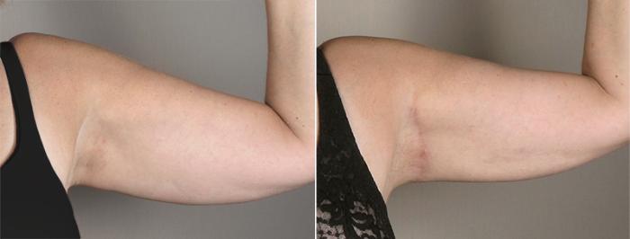 Upper Arm Rejuvenation Case 829 Before & After View #2 | Paramus, New Jersey | Parker Center for Plastic Surgery