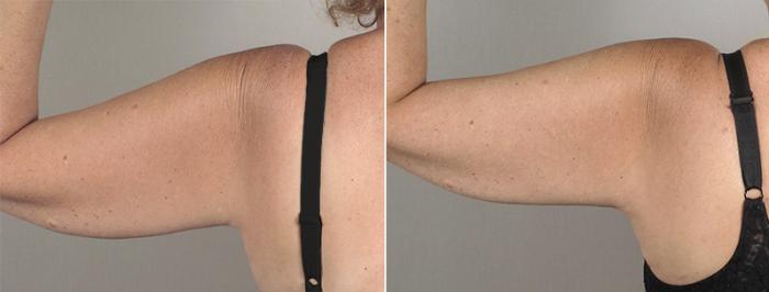 Upper Arm Rejuvenation Case 829 Before & After View #3 | Paramus, New Jersey | Parker Center for Plastic Surgery