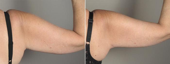 Upper Arm Rejuvenation Case 829 Before & After View #4 | Paramus, New Jersey | Parker Center for Plastic Surgery