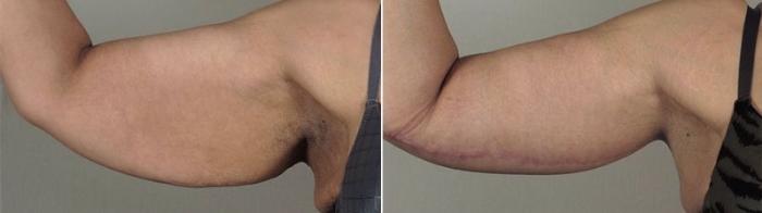 Upper Arm Rejuvenation Case 830 Before & After View #1 | Paramus, New Jersey | Parker Center for Plastic Surgery