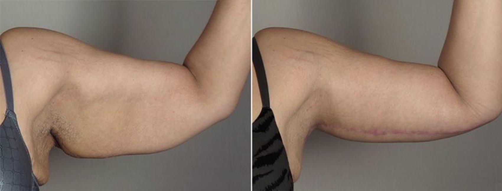 Upper Arm Rejuvenation Case 830 Before & After View #2 | Paramus, New Jersey | Parker Center for Plastic Surgery