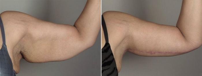 Arm Lift Case 830 Before & After View #2 | Paramus, New Jersey | Parker Center for Plastic Surgery