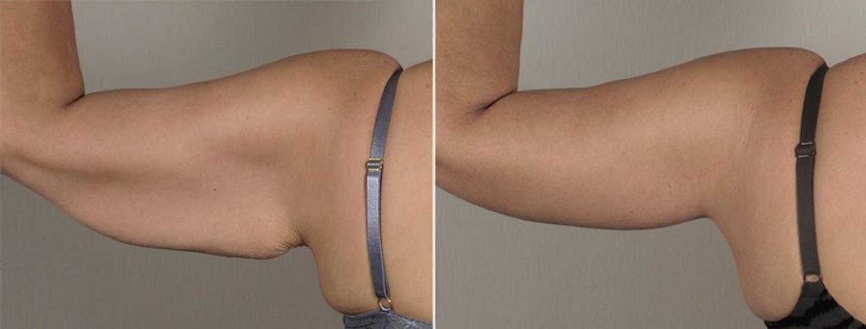 Upper Arm Rejuvenation Case 830 Before & After View #3 | Paramus, New Jersey | Parker Center for Plastic Surgery