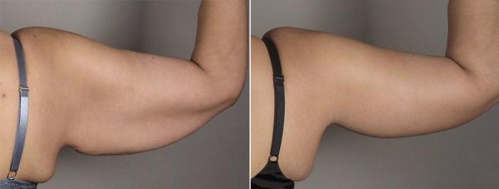 Arm Lift Case 830 Before & After View #4 | Paramus, New Jersey | Parker Center for Plastic Surgery