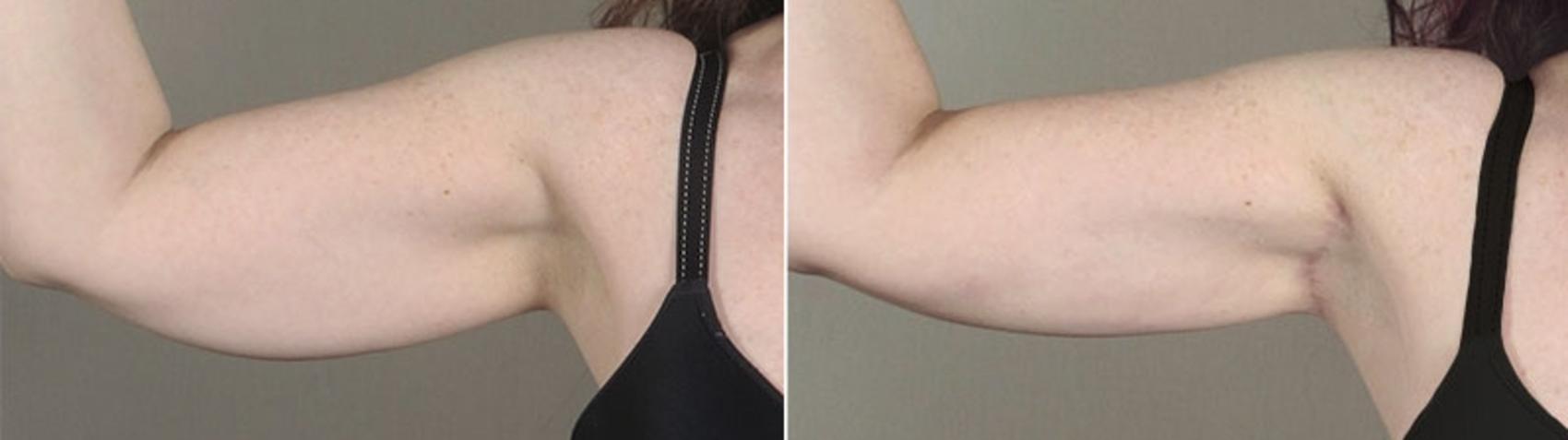 Upper Arm Rejuvenation Case 831 Before & After View #1 | Paramus, New Jersey | Parker Center for Plastic Surgery