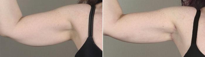 Upper Arm Rejuvenation Case 831 Before & After View #1 | Paramus, New Jersey | Parker Center for Plastic Surgery