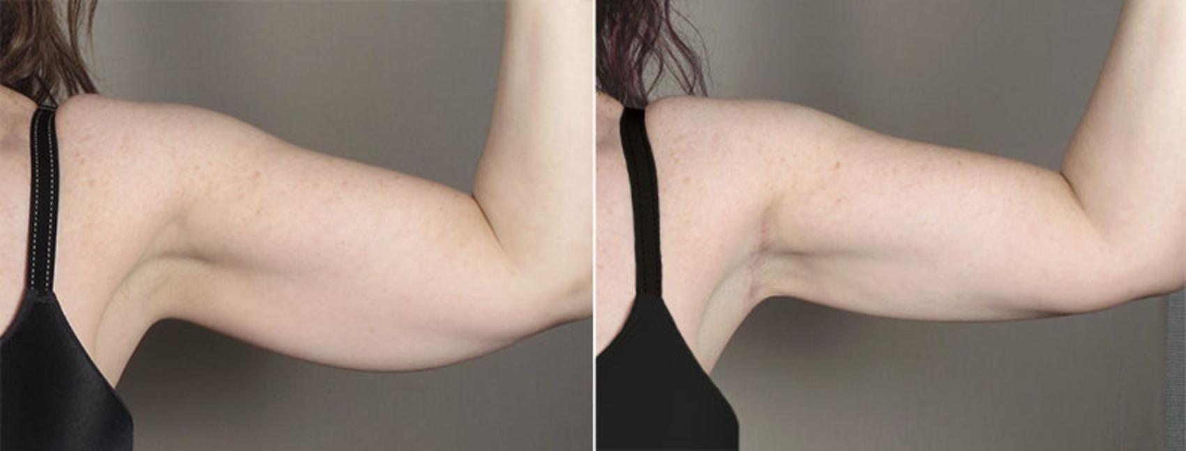 Upper Arm Rejuvenation Case 831 Before & After View #2 | Paramus, New Jersey | Parker Center for Plastic Surgery
