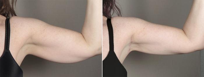 Upper Arm Rejuvenation Case 831 Before & After View #2 | Paramus, New Jersey | Parker Center for Plastic Surgery