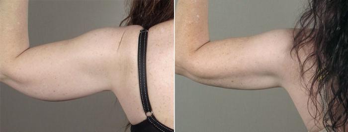 Upper Arm Rejuvenation Case 831 Before & After View #3 | Paramus, New Jersey | Parker Center for Plastic Surgery