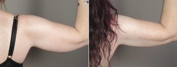 Upper Arm Rejuvenation Case 831 Before & After View #4 | Paramus, New Jersey | Parker Center for Plastic Surgery