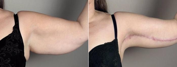 Upper Arm Rejuvenation Case 832 Before & After View #2 | Paramus, New Jersey | Parker Center for Plastic Surgery