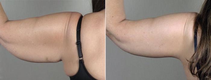 Upper Arm Rejuvenation Case 832 Before & After View #3 | Paramus, New Jersey | Parker Center for Plastic Surgery