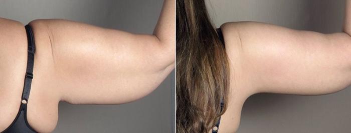 Upper Arm Rejuvenation Case 832 Before & After View #4 | Paramus, New Jersey | Parker Center for Plastic Surgery