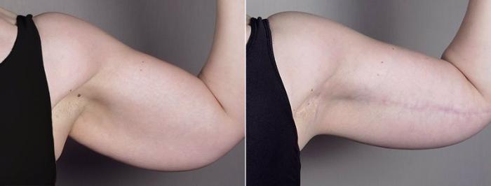Upper Arm Rejuvenation Case 833 Before & After View #2 | Paramus, New Jersey | Parker Center for Plastic Surgery