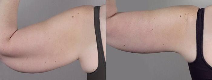 Upper Arm Rejuvenation Case 833 Before & After View #3 | Paramus, New Jersey | Parker Center for Plastic Surgery