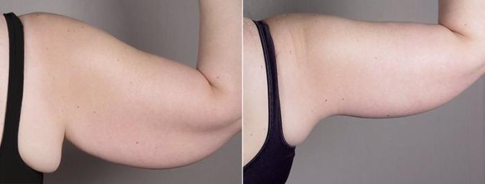 Upper Arm Rejuvenation Case 833 Before & After View #4 | Paramus, New Jersey | Parker Center for Plastic Surgery