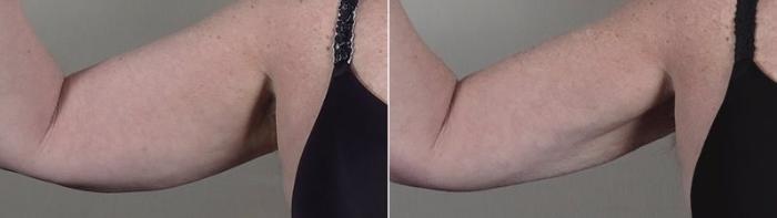Upper Arm Rejuvenation Case 834 Before & After View #1 | Paramus, New Jersey | Parker Center for Plastic Surgery