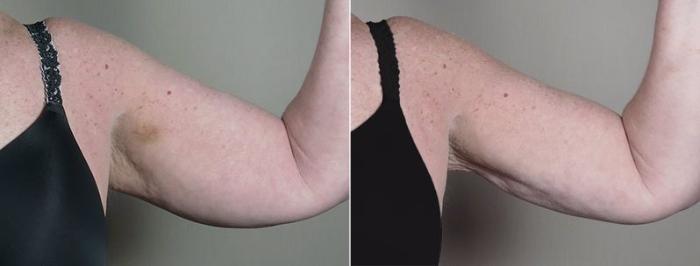 Upper Arm Rejuvenation Case 834 Before & After View #2 | Paramus, New Jersey | Parker Center for Plastic Surgery