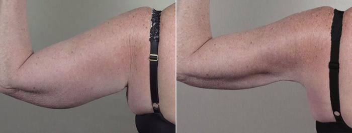 Upper Arm Rejuvenation Case 834 Before & After View #3 | Paramus, New Jersey | Parker Center for Plastic Surgery
