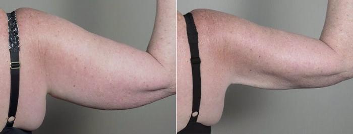 Upper Arm Rejuvenation Case 834 Before & After View #4 | Paramus, New Jersey | Parker Center for Plastic Surgery