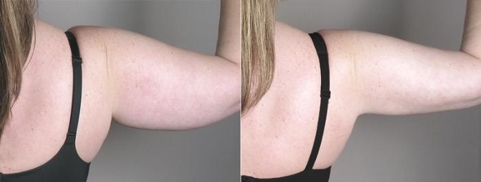 Upper Arm Rejuvenation Case 928 Before & After View #5 | Paramus, New Jersey | Parker Center for Plastic Surgery
