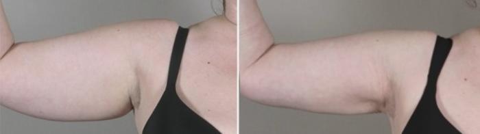 Upper Arm Rejuvenation Case 932 Before & After View #5 | Paramus, New Jersey | Parker Center for Plastic Surgery
