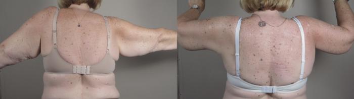 Upper Arm Rejuvenation Case 988 Before & After Back | Paramus, New Jersey | Parker Center for Plastic Surgery