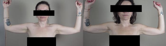 Upper Arm Rejuvenation Case 989 Before & After Front | Paramus, New Jersey | Parker Center for Plastic Surgery